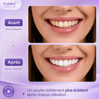 Bandes blanchissantes Turbo Smile - Kit